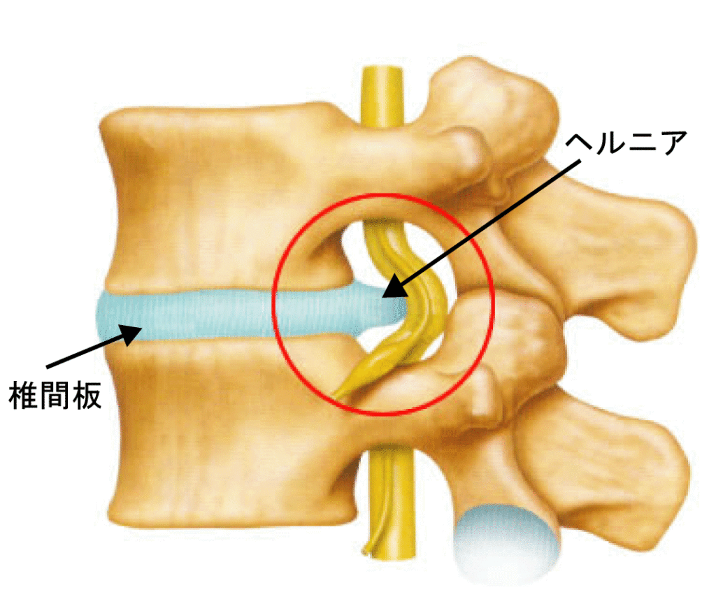 椎間板ヘルニアが起きるメカニズムを知っていますか？